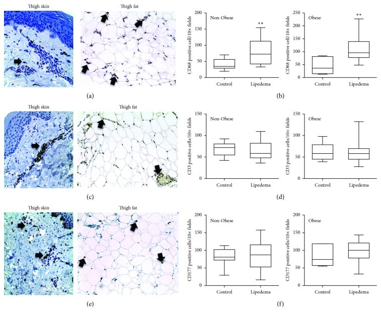Figura científica do manual: classificação e estadiamento do lipedema por graus e tipos morfológicos.